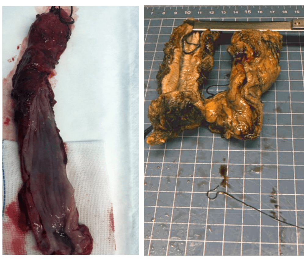 月20日在全麻下行"食管癌三野根治术 右肺上叶楔形切除术 空肠造瘘术"