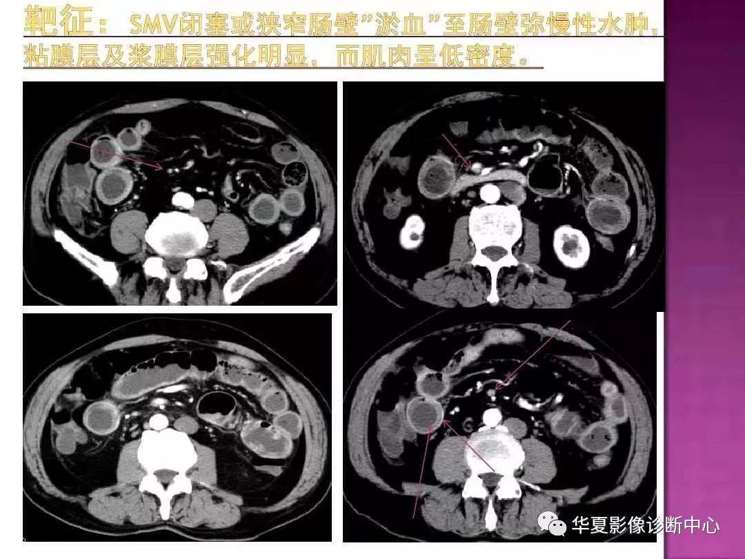 ct上如何寻找肠梗阻的梗阻点