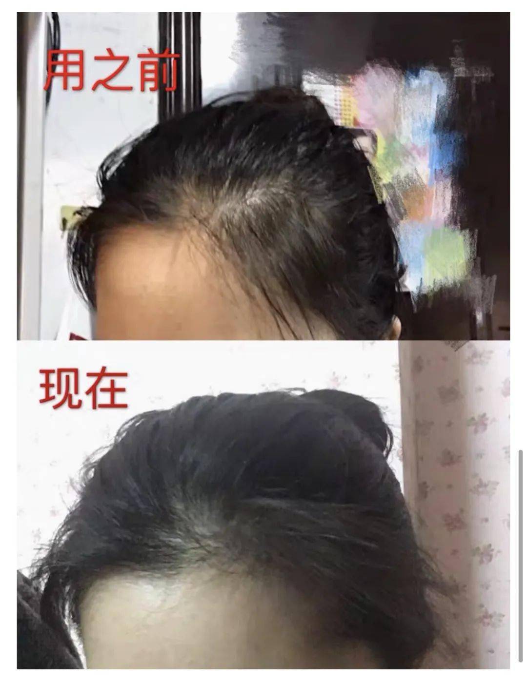 毛囊|流女星们的“狮子头”都是假象？录节目竟然当场掉下假发片，真相竟然是……