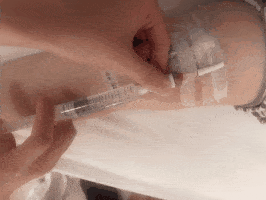 动图:使用正压技术冲,封管