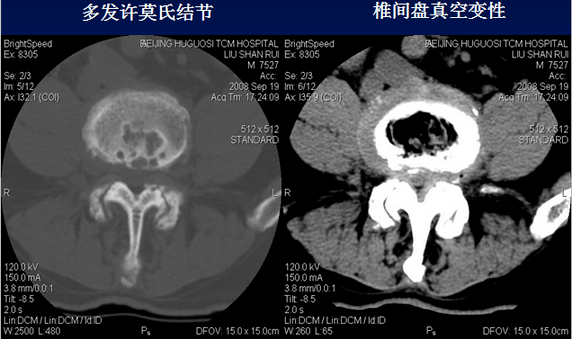 腰椎ct诊断:椎间盘突出,椎管狭窄,退行性改变