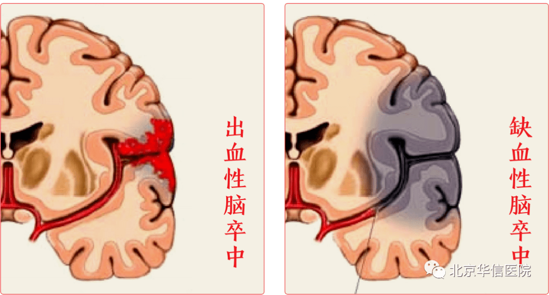 义诊|【义诊预告】医体融合，预防卒中；科学运动，健康生活