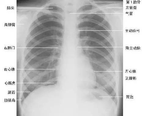 纵隔|读完此文，终于学会看胸片了
