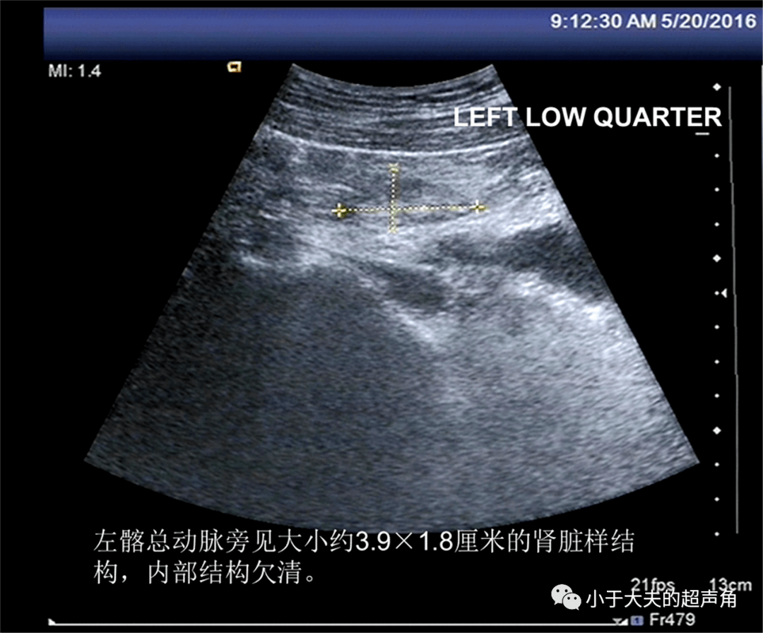 诊断|【超声随响】第21期 肾脏先天性发育异常 诊断肾缺如要谨慎!