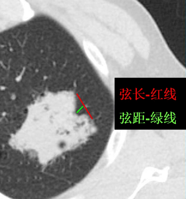 = 3/10 为中分叶;肺癌常见深分叶错构瘤及结核球可呈浅分叶,炎性假瘤