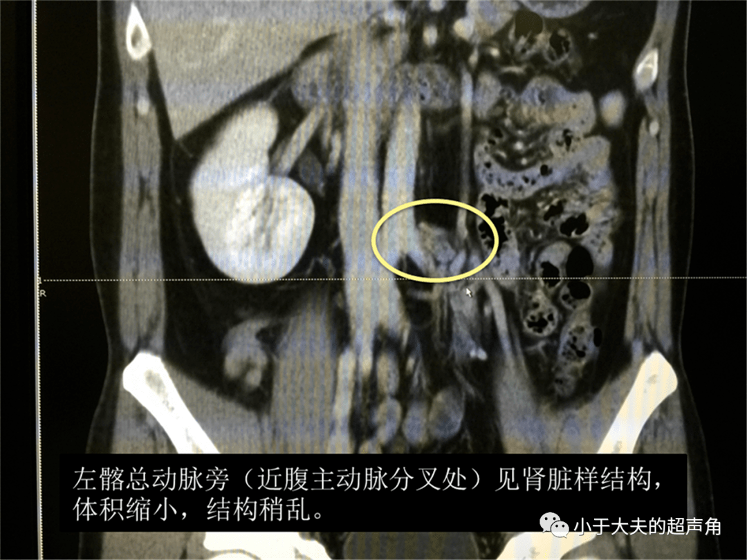 诊断|【超声随响】第21期 肾脏先天性发育异常 诊断肾缺如要谨慎!