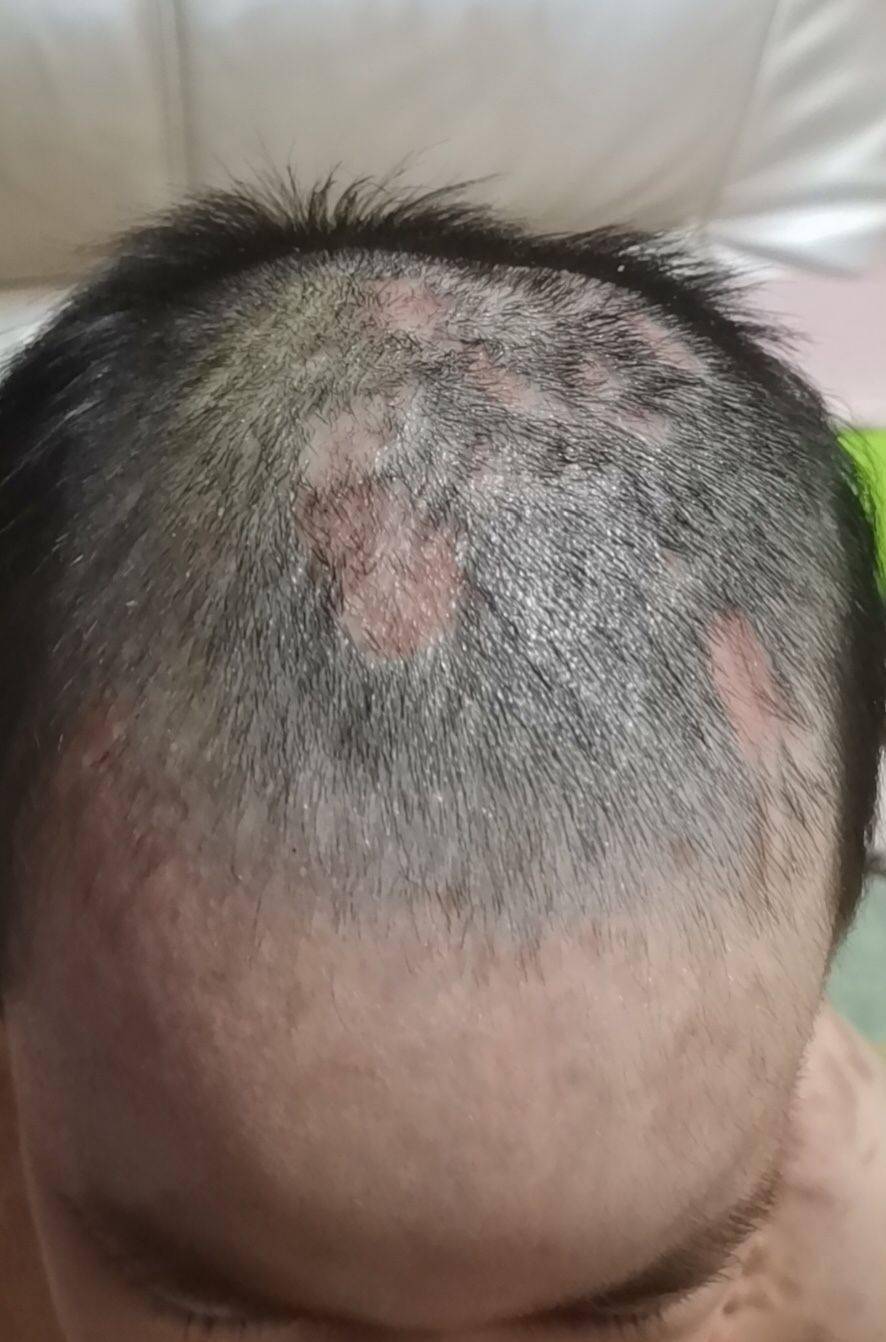 医生在遭生母与男友虐待女童腿上取出钢针