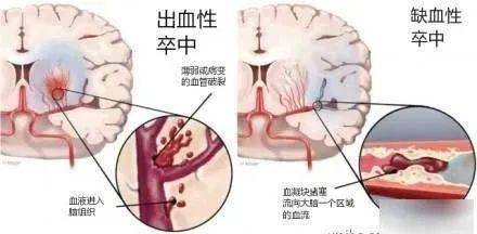 常分为缺血性和出血性两大类，不同部位的卒中所导致的症状也不尽相同。