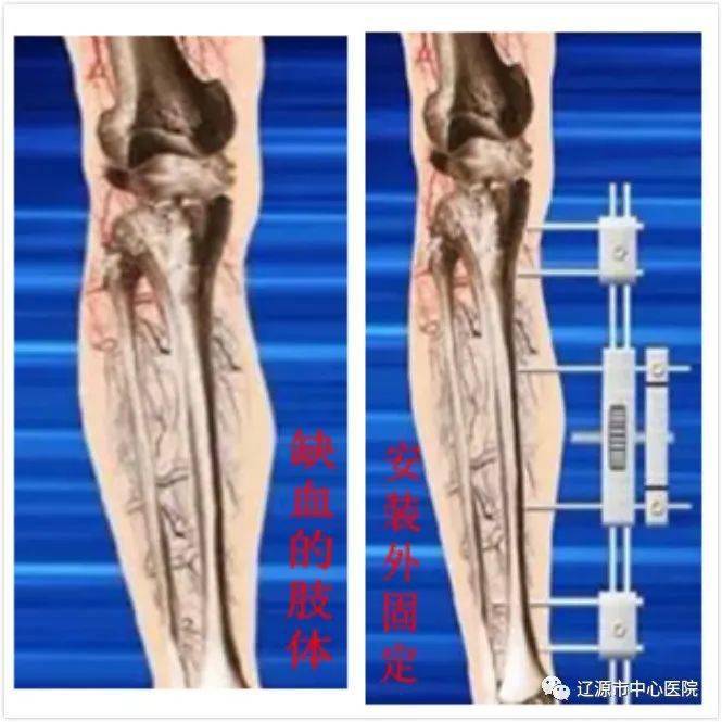 糖尿病足治疗新技术胫骨横向骨搬移术