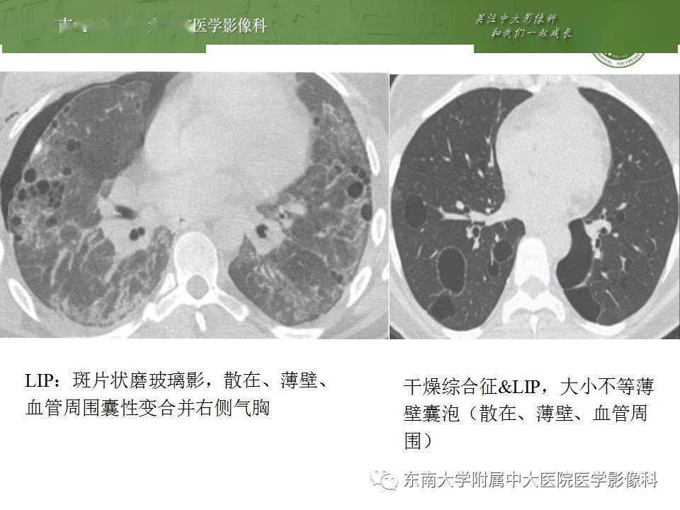 胸部丨肺气肿的ct诊断及相关鉴别诊断
