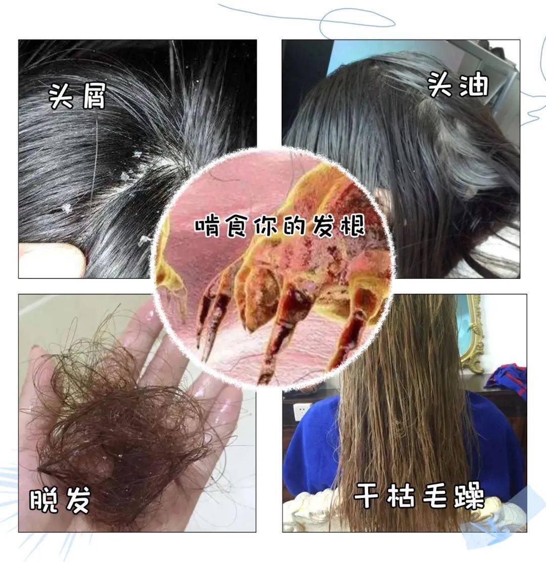 更可怕的是,螨虫给你的头皮 制造垃圾,堵塞毛孔 还以啃食你的发根