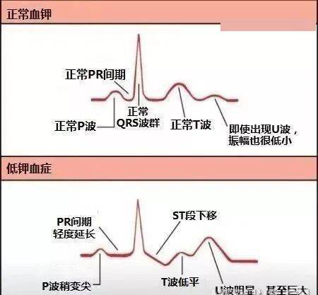 低血钾的心电图表现