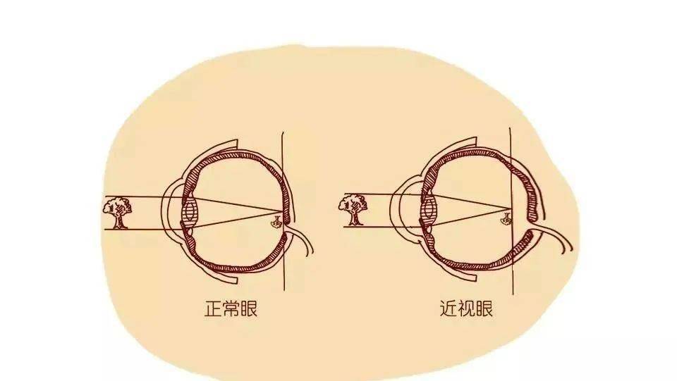 眼球?眼轴?这到底是个啥呢?这跟又近视有啥关系呢?