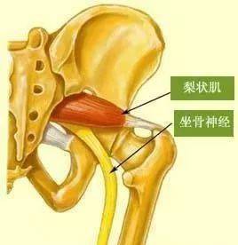 肌肉和挛急的坐骨神经干线所支配的肌肉产生挛急性的疼痛,因此,梨状肌