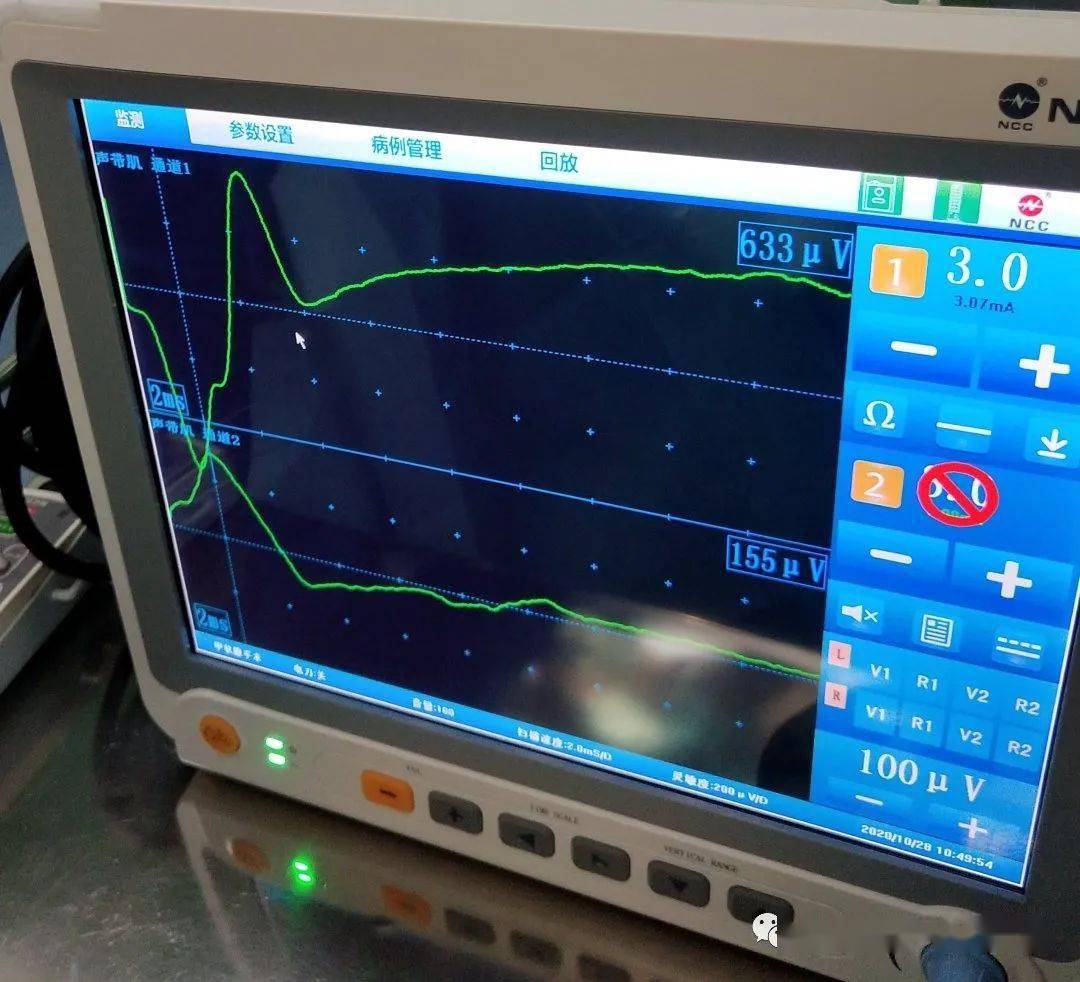 喉返神经监测仪为术中神经安全保驾护航