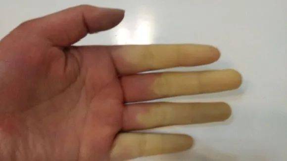 接触冻鱼后,杭州一阿姨手指迅速变白,还感到"刺骨的"冷
