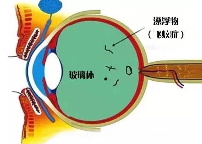 飞蚊症也叫玻璃体浑浊,是玻璃体腔中出现点状或条索状的不透明物质