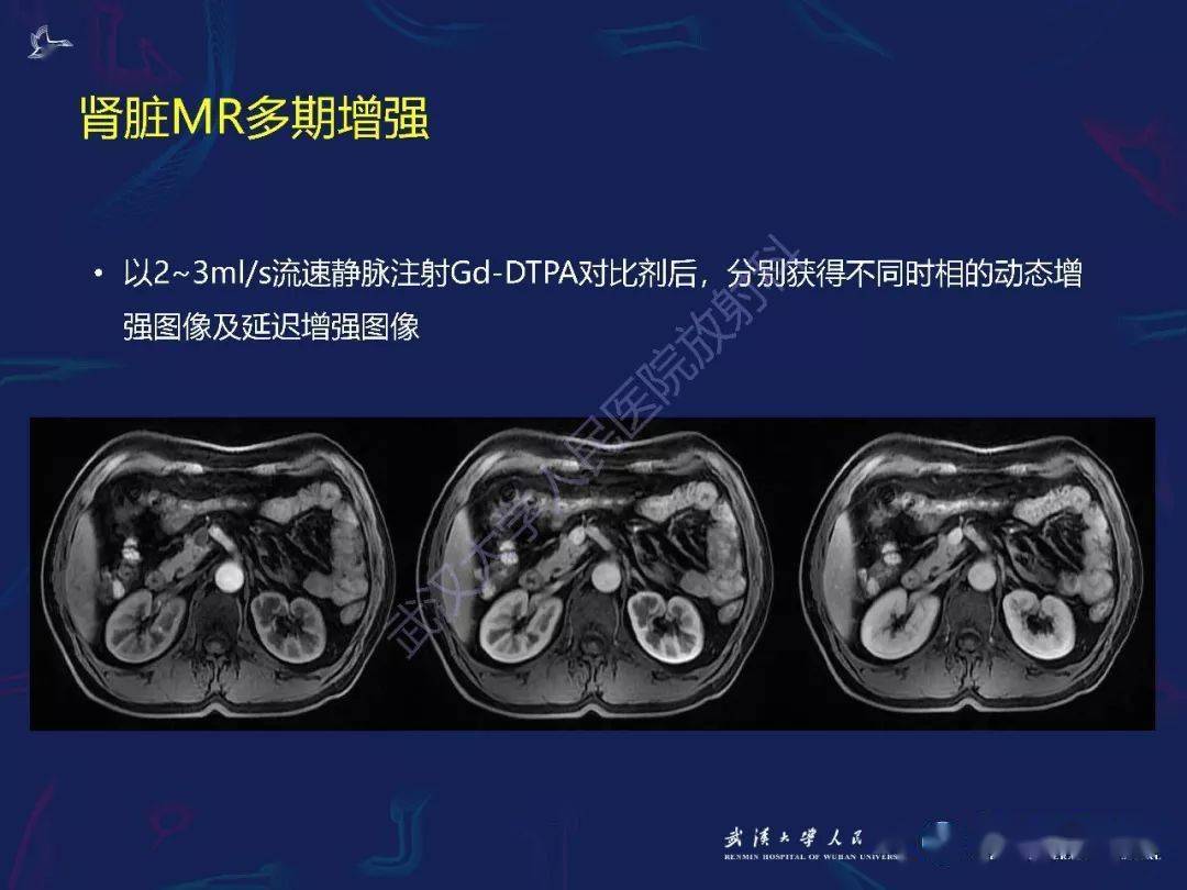 精彩推荐 常见肾脏肿瘤影像诊断