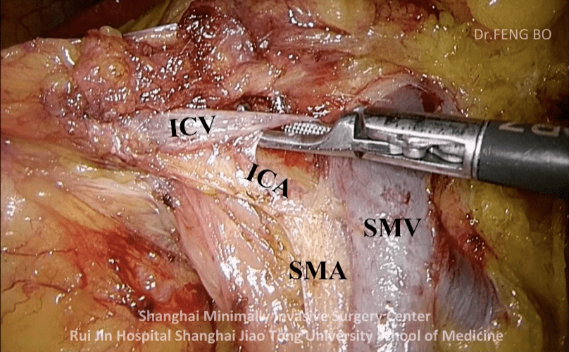是  系膜间间隙 从 下往上由 trcs 拓展进入,从下往上解剖结肠中血管