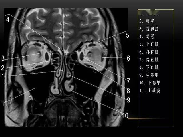 mri下眼部及鼻窦解剖图谱