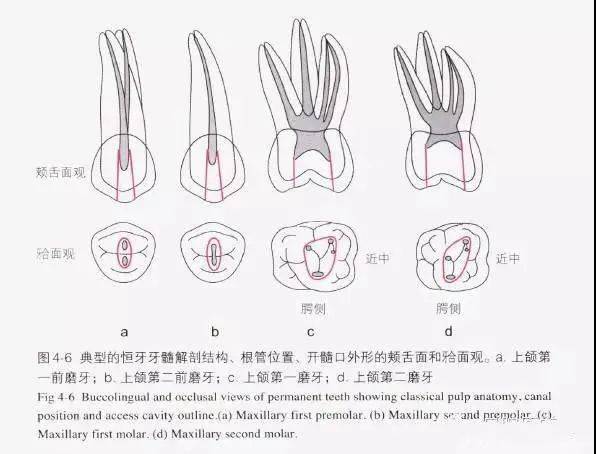 标准开髓口形态