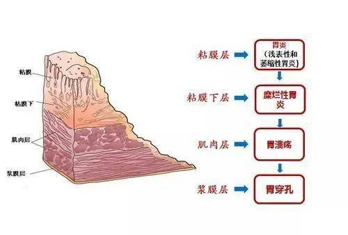 性溃疡之间的一种临床常见的消化系统疾病,它症状一般表现于饭后饱胀