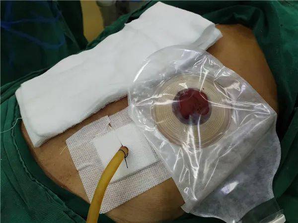 南宁一女子长期便秘腹痛手术时粪水不断流出医生处理不及时会要命