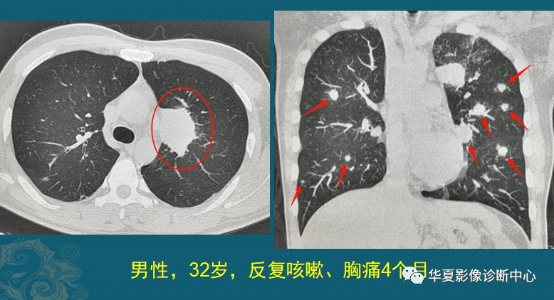 前几天遇到一位年轻的肺癌病人,才32岁,肺腺癌晚期,多发转移了