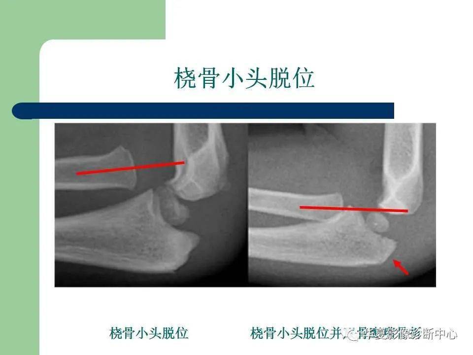 【影像基础】儿童肘关节损伤x线诊断_桡骨