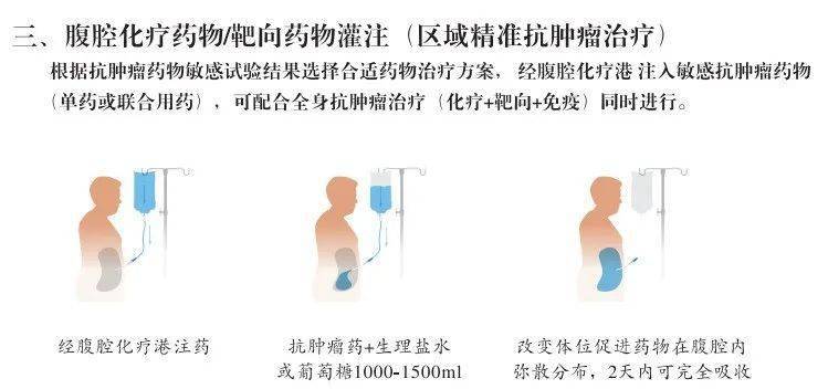 手术|四期腹膜转移胃癌患者还有手术机会吗？外科专家这样说