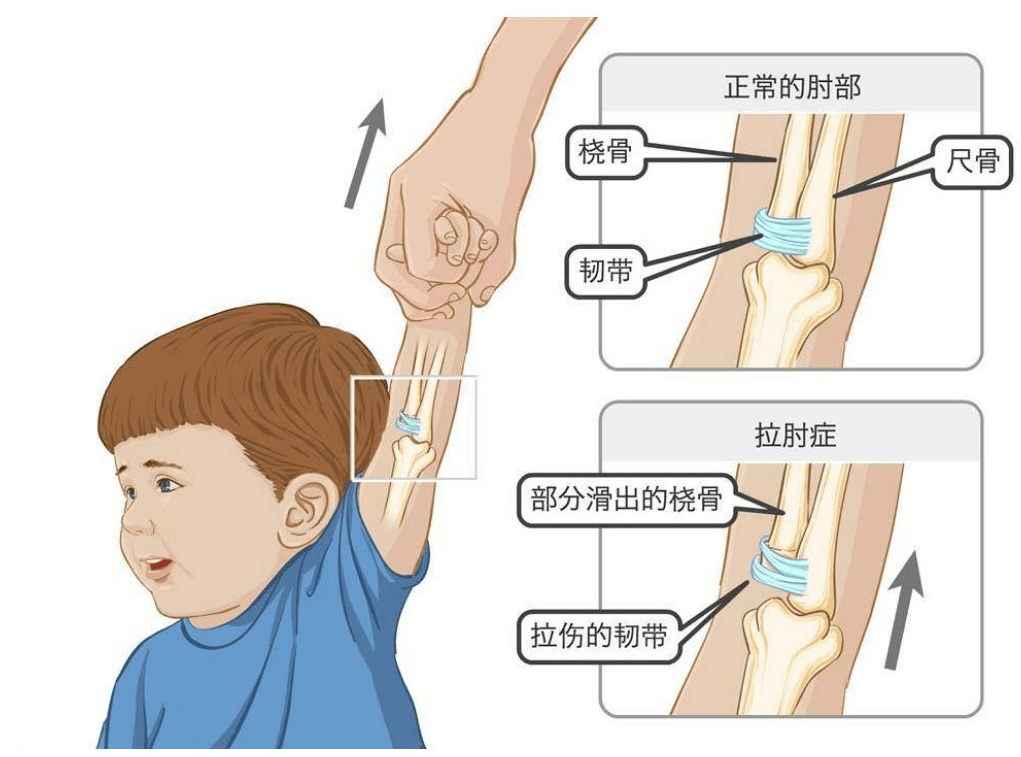 四岁孩子被家长玩成习惯性脱臼痛苦一生这个动作真的做不得