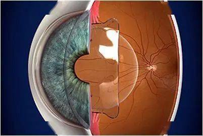 眼角膜是怎样形成的 0b82dae4182f4031a971a84401e5c112.jpeg