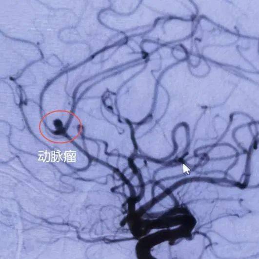 "拆弹"成功!—— 我院完成首例急性破裂脑动脉瘤栓塞术