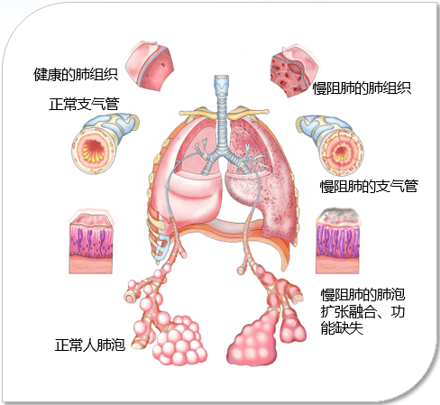 那么,慢阻肺究竟是怎么的一种疾病呢?它的症状表现是什么呢?