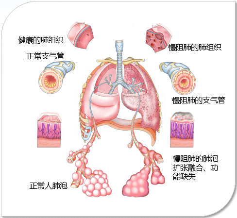 世界慢阻肺日咳嗽咳痰呼吸困难小心慢阻肺找上门