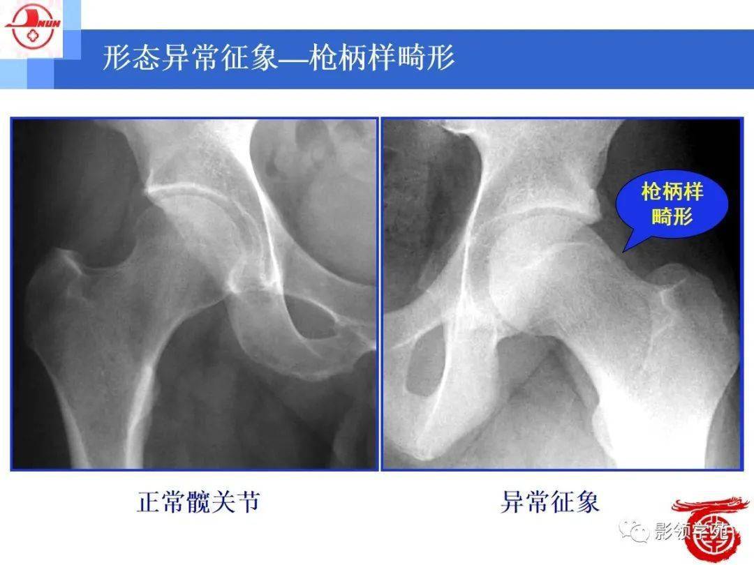 髋臼缘或髋臼唇的异常表现为髋臼缘的增生,硬化;以及髋臼唇形态的