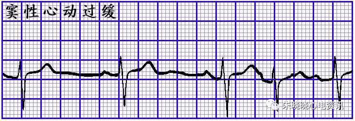 心电图表现为窦性心动过缓,窦性停搏,窦房阻滞,以及各种类型的缓慢性