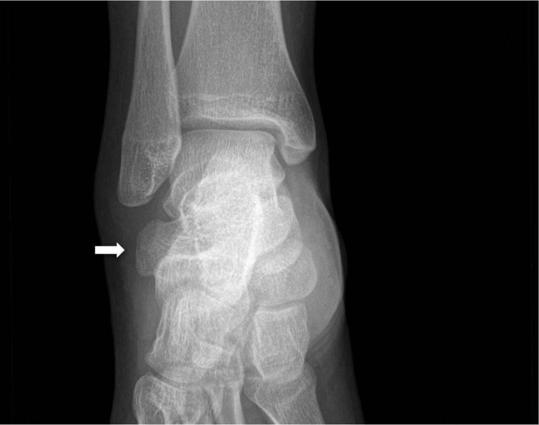 12种常见足踝部籽骨、小骨及变异_综合征