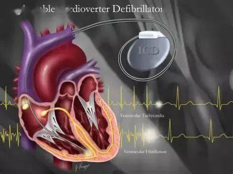 复律除颤器(implantable cardiovision defibrillator, icd)植入术