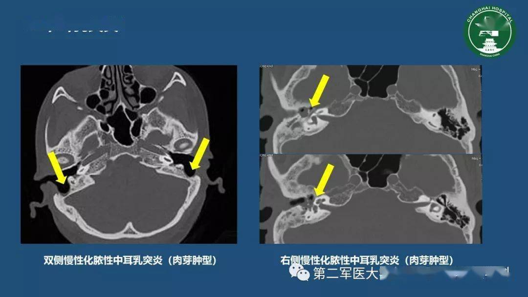 颞骨ct解剖及其常见病变