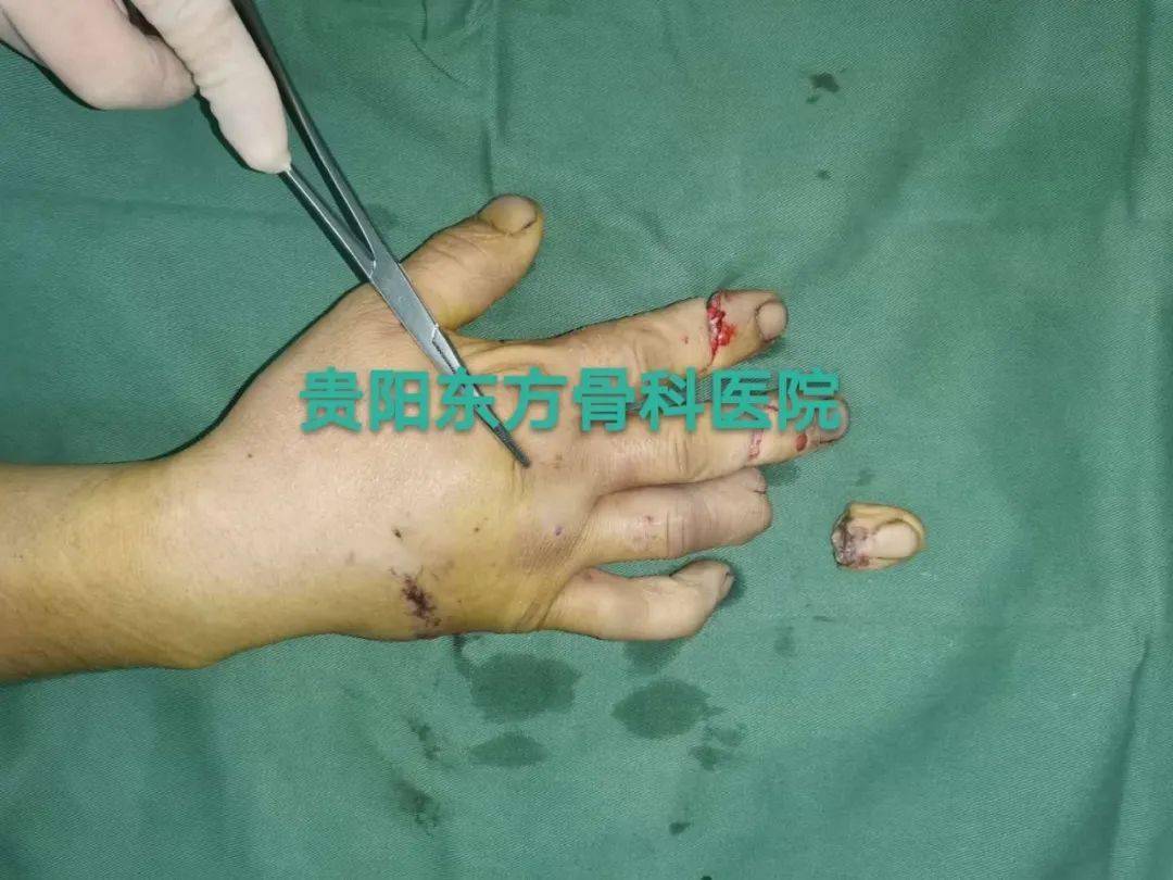 手摔断了多久能好 d3d3ce543da5489cb75a9028a950e8f0.jpeg