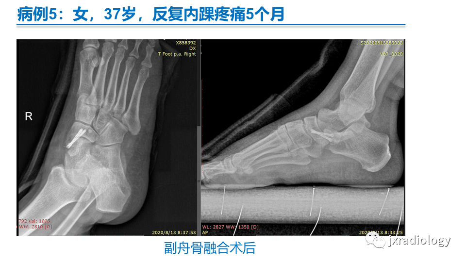 足副舟骨分型及相关病变的影像表现