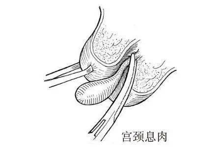 为什么会出现同房出血,是宫颈癌变吗?