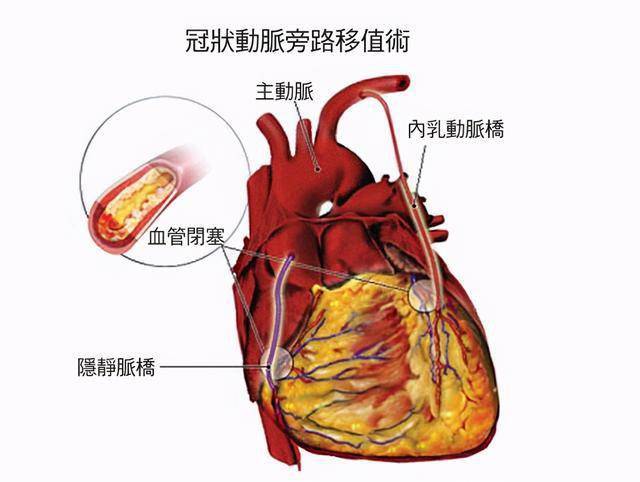 冠状动脉搭桥术后女性患者能生育吗?