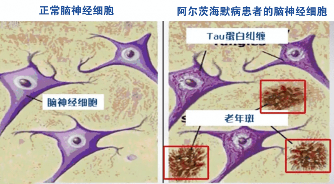 地下室零下80℃的大冰箱里,珍藏着揭开阿尔茨海默病谜底的钥匙_大脑