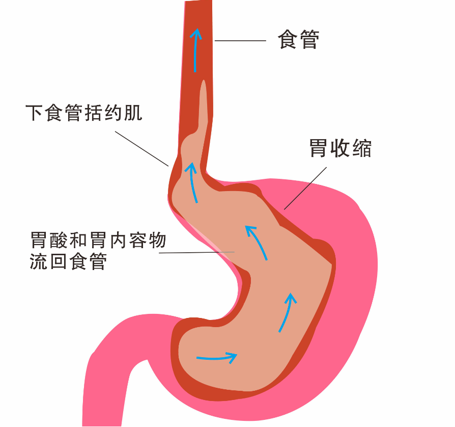 如何排查胃食管反流?