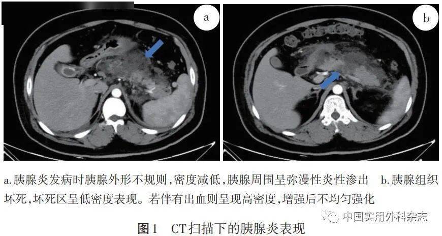 专题笔谈|影像学在胆源性胰腺炎诊治中价值及评价