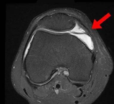 mri fs pdwi像示髌内侧滑膜皱襞综合征.