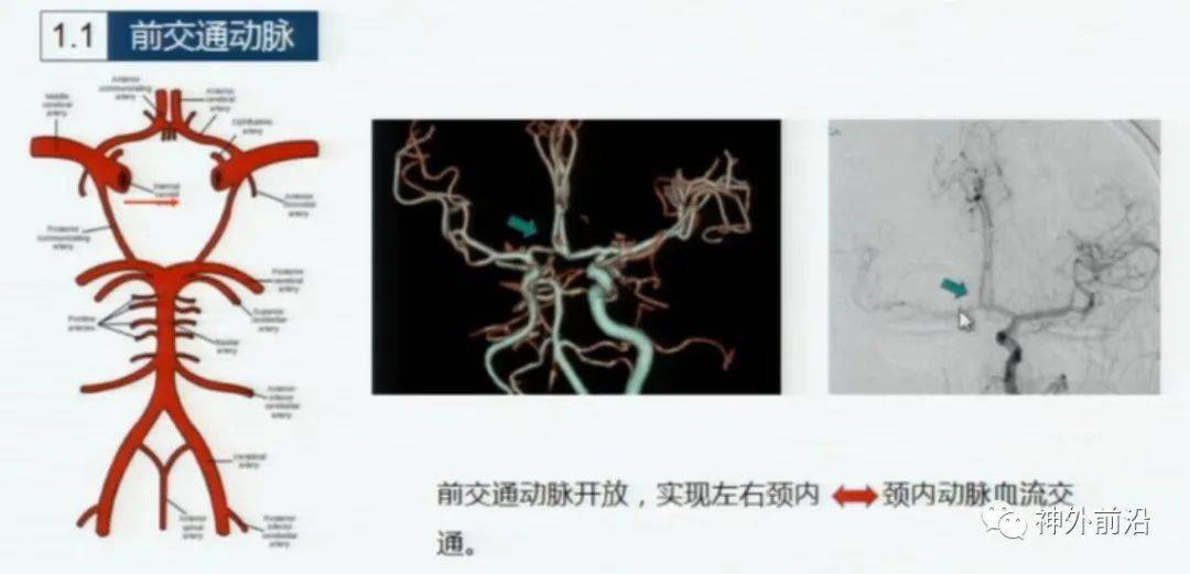 神刀博览 | 天坛医院张岩:伴对侧颈动脉闭塞的颈动脉狭窄的手术策略