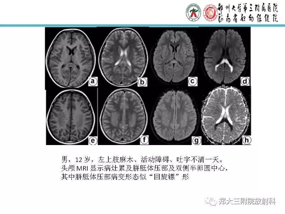 可逆性胼胝体压部病变综合征的影像分析